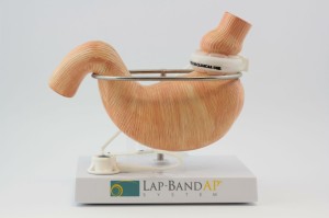 lap-band-surgery-los-angeles