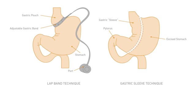 gastric sleeve vs lap band