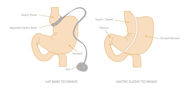 Gastric Band Surgery (LAP-Band): What It Is, Requirements & Procedure