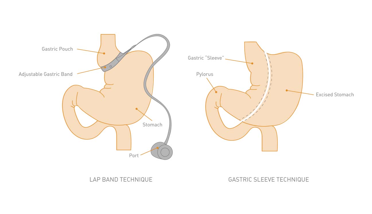 What is Lap Band Surgery & its Side Effects? | Better Weigh Center